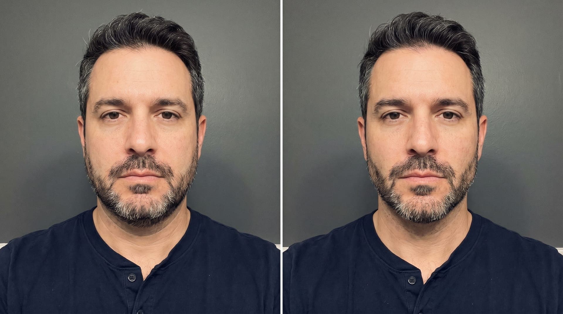 Before and after example: Sharper mandibular angle. Reduced submental fat.